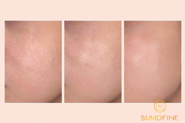 TOP 5 serum phục hồi da mỏng nổi mạch máu & cách sử dụng an toàn 4 cách chọn serum theo mục tiêu và vấn đề da
