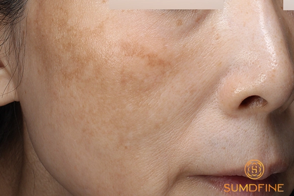 Những cách trị nám gò má