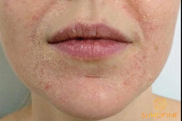 Da khô có cần routine skincare riêng biệt không?