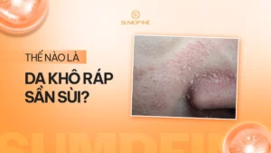 Nhận diện tình trạng Da khô rát sần sùi