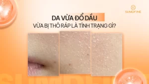 Da vừa đổ dầu vừa khô là tình trạng gì