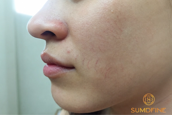 TOP 5 serum phục hồi da mỏng nổi mạch máu & cách sử dụng an toàn 2 Chọn hoạt chất làm dày da để mạch máu bớt lộ