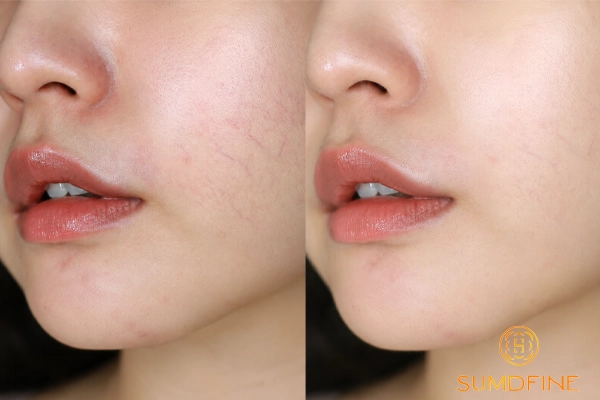 TOP 5 serum phục hồi da mỏng nổi mạch máu & cách sử dụng an toàn 3 Hoạt chất phục hồi hàng rào da mỏng yếu