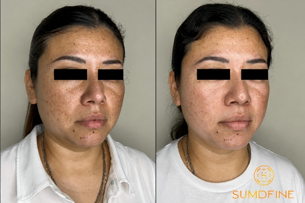 Review kem trị nám Obagi Nu Derm