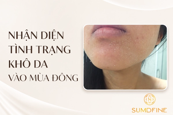 Những dấu hiệu cho thấy mùa đông da bị khô hơn