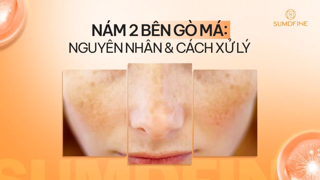 Nám 2 bên gò má