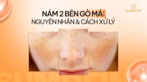 Nám 2 bên gò má