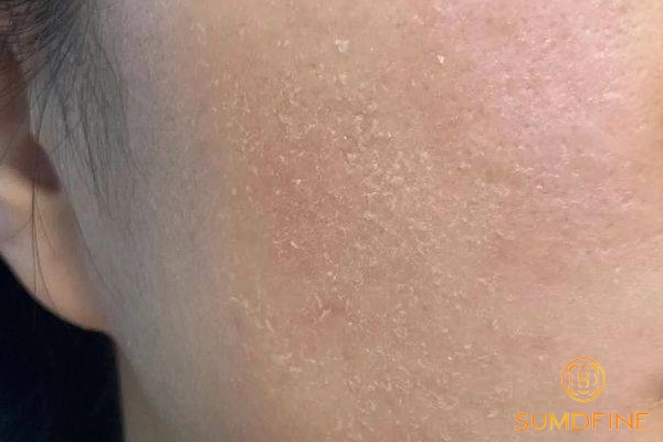 Dấu hiệu điển hình của da thiếu chất