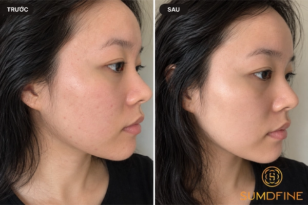 Đánh giá các loại serum phục hồi cho da sau peel
