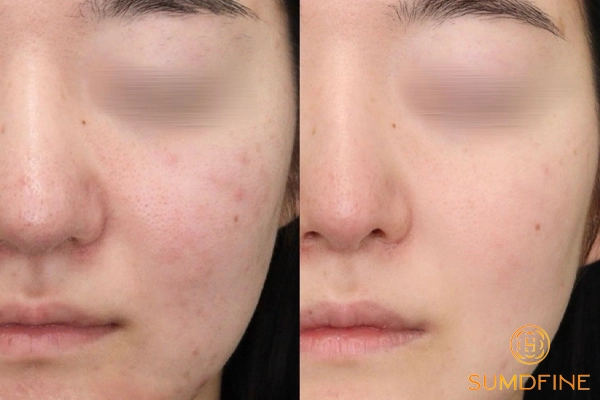 Phục hồi cho da sau peel với serum Sumdfine B5