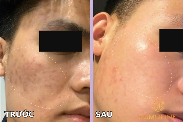 Review kem trị nám La Roche Posay Mela B3