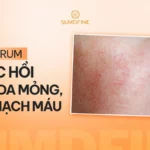 TOP 5 serum phục hồi da mỏng nổi mạch máu & cách sử dụng an toàn