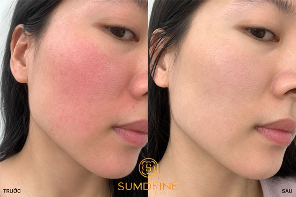 Serum Hàn quốc cho da khô - Sumdfine Repair Serum B5