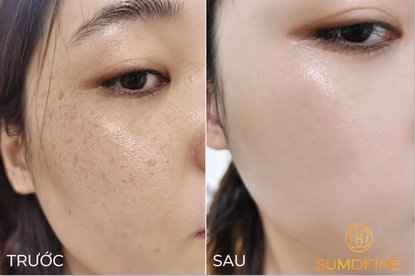Kem trị nám Sumdfine - review từ người dùng thật