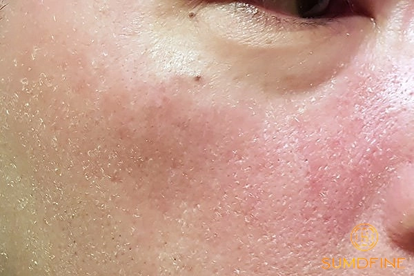 Tẩy tế bào chết cho da khô quá thường xuyên - sai lầm thường gặp