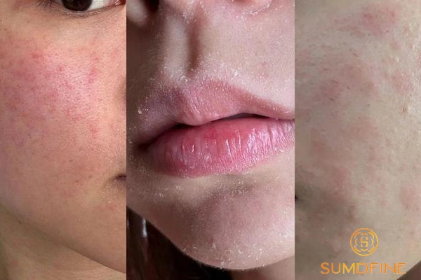 Tiêu chí chọn sản phẩm giúp phục hồi da mỏng yếu