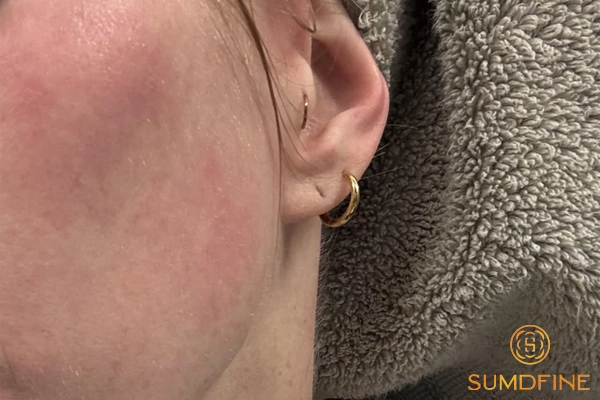 Tiêu chí chọn kem chống nắng cho da đang treatment