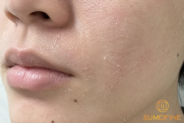 5 cách xử lý da khô căng sau khi rửa mặt để da ẩm mịn trở lại 3 Da khô căng bong tróc sau khi rửa mặt