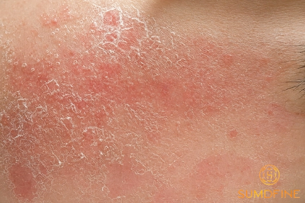 Da mặt bị khô đỏ, hơi rát: Nguyên nhân & Cách xử lý cho từng trường hợp 2 Da mặt khô, rát, ửng đỏ, đôi khi kèm ngứa
