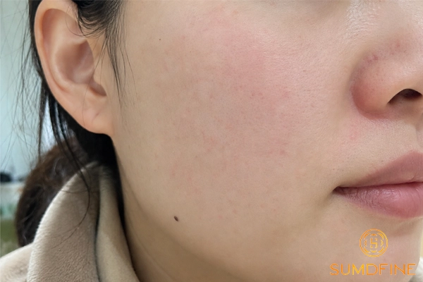 Cách chăm sóc da khô nhạy cảm: 7 bước phục hồi hàng rào da hiệu quả 2 Dấu hiệu cho thấy da bạn là da khô nhạy cảm