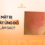 Da mặt bị khô đỏ, hơi rát: Nguyên nhân & Cách xử lý cho từng trường hợp