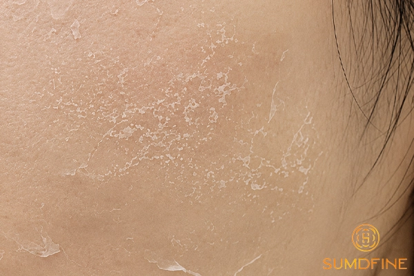 5 nguyên nhân khiến da bị khô rát, bong vảy khi dùng vitamin C & Cách xử lý 3 Da khô tróc vảy do độ pH của vitamin C quá thấp