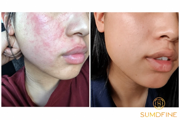 Vì sao da treatment nên lựa chọn kem chống nắng phù hợp, an toàn, không kích ứng