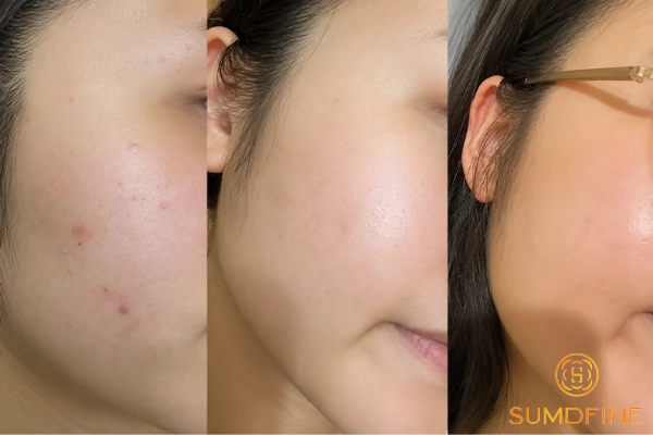 Dùng Retinol da bị khô bong phải xử lý ra sao để nhanh hết? 6 Kết quả khi dùng retinol đúng cách