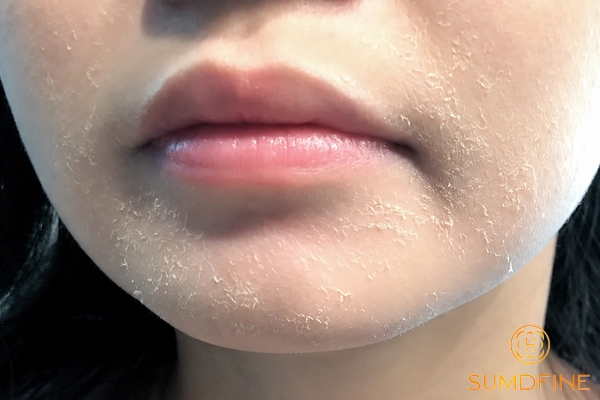 Dùng Retinol da bị khô bong phải xử lý ra sao để nhanh hết? 2 Da bị khô bong tróc vảy khi dùng reinol