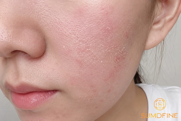 Da mặt bị khô đỏ, hơi rát: Nguyên nhân & Cách xử lý cho từng trường hợp 4 Đỏ da, ngứa rát do mỹ phẩm không phù hợp