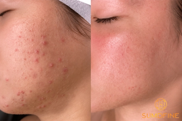 Những sai lầm cần tránh khi dùng kem chống nắng cho da treatment