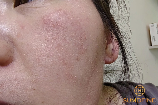 Da mặt bị khô đỏ, hơi rát: Nguyên nhân & Cách xử lý cho từng trường hợp 8 Sai lầm cần tránh khi da bị khô đỏ rát