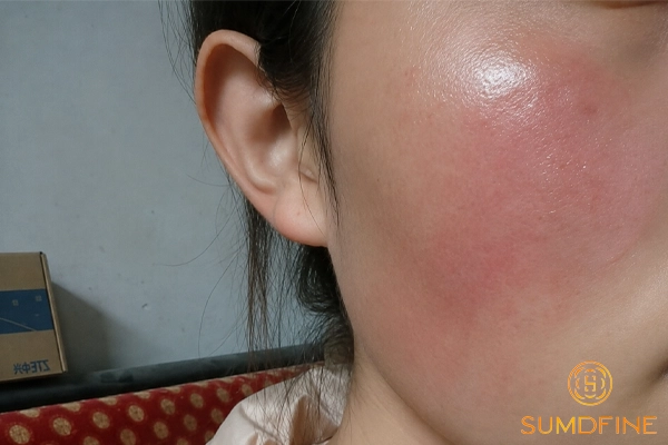Đỏ mặt khi thoa kem chống nắng có phải do dị ứng không?