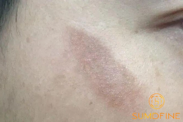Vết thương lên da non bị đỏ, thâm: Nguyên nhân & Cách xử lý 5 Cách xử lý vết thương lên da non bị thâm