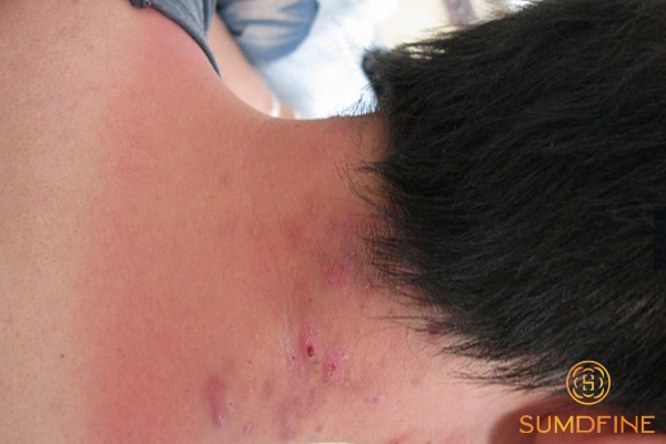 Cách chống nắng khi làm việc ngoài trời để bảo vệ da hiệu quả 3 Hậu quả khi làm việc ngoài trời nhưng không chống nắng kỹ càng các vùng da