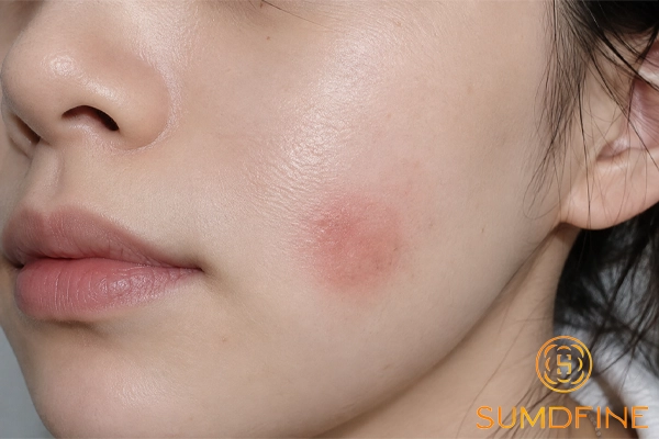 Vết thương lên da non bị đỏ, thâm: Nguyên nhân & Cách xử lý 2 Da non xuất hiện từ vết thương