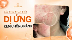 Dấu hiệu da bị dị ứng kem chống nắng