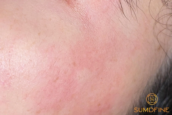 Dấu hiệu dị ứng kem chống nắng