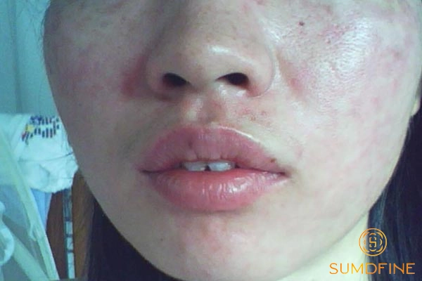 Dùng serum B5 bị ngứa: dấu hiệu dị ứng hay kích ứng? 4 Nền da yếu gây tăng nguy cơ phản ứng