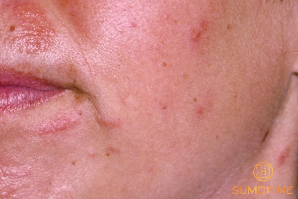 Dùng serum B5 bị ngứa: dấu hiệu dị ứng hay kích ứng? 2 Lý do dùng serum b5 bị ngứa