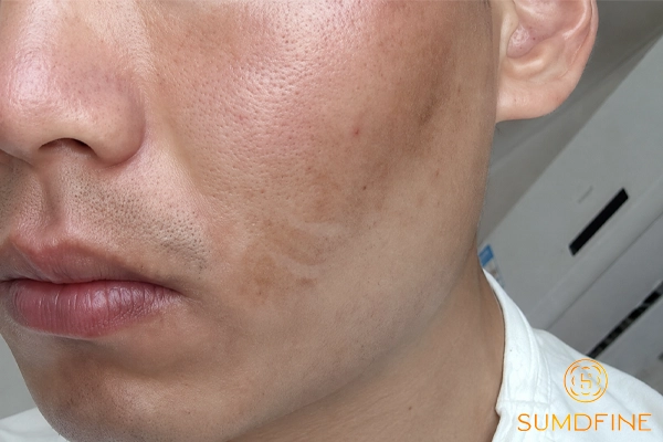 Sau khi peel da bị thâm phải làm sao? Cách chăm sóc và xử lý an toàn 2 Thâm da sau khi peel có phải dấu hiệu đáng lo?