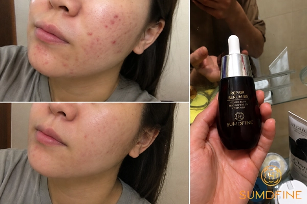 Top 9 serum tái tạo da hiệu quả được người dùng đánh giá cao 4 Trải nghiệm serum tái tạo da Sumdfine Repair Serum B5