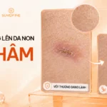 Vết thương lên da non bị đỏ, thâm: Nguyên nhân & Cách xử lý