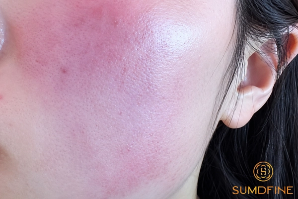 Cách xử lý khi bị dị ứng kem chống nắng