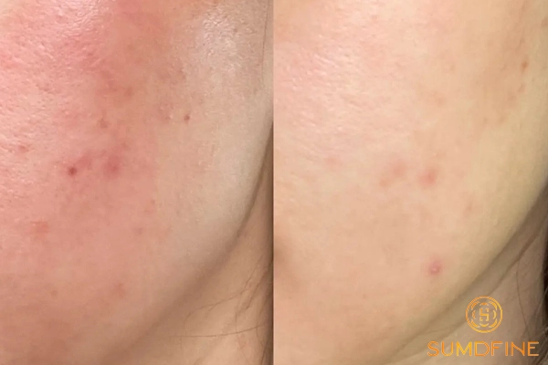 Cách để mặt hết đỏ khi dùng kem chống nắng