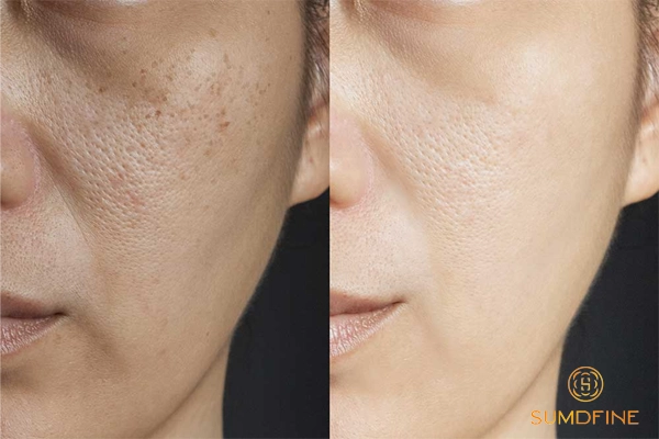 Vitamin C hay Arbutin trị nám da hiệu quả hơn? 3 Khi nào nên chọn arbutin để trị nám