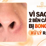 8 Lý Do Da Hai Bên Cánh Mũi Bị Khô, Bong Tróc & Cách Xử Lý Hiệu Quả