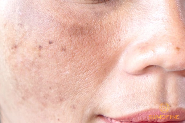 Sắc tố melanin là gì? Vai trò với da và mối liên hệ với nám, sạm 5 Tăng sắc tố melanin