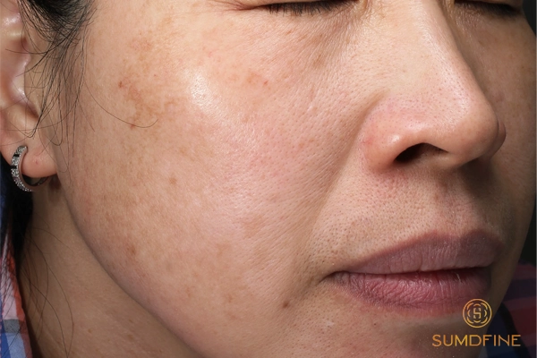 So sánh viên uống và kem bôi trị nám & cách kết hợp hiệu quả 3 Ai không nên dùng viên uống trị nám?