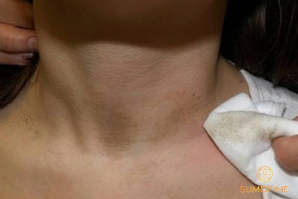 Da vùng cổ bị sạm đen: Nguyên nhân & 3 cách xử lý hiệu quả 5 Phân biệt thâm sạm cổ thông thường với bệnh gai đen